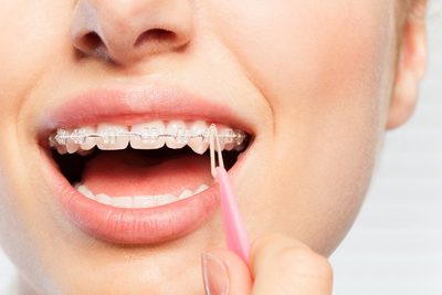 【歯科医が解説】矯正の「ゴム掛け」の意味とは？サボるとどうなる？効果や期間ものアイキャッチ画像